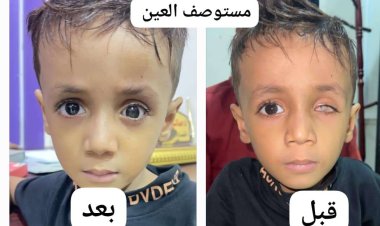 مستوصف بعدن ينقذ طفلاً من التنمر بإجراء عملية تجميلية مجانية