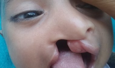 طفل بأبين يعاني من تشوه خلقي وأسرته تناشد فاعلي الخير