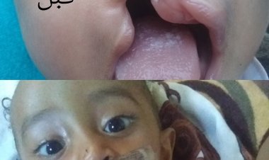 استجابة لما نشره موقع «حدث اليوم» الطفل حسن علي حسن يجري عملية تصحيح تشوه خلقي