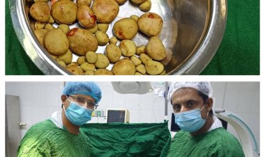 في عملية معقدة.. استخراج 61 حصوة من مريض في مستشفى بشبوة