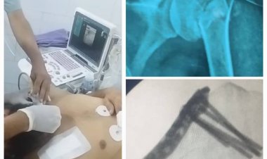 لأول مرة في العاصمة عدن فريق طبي ينجح باجراء عملية نوعية باستخدام التخدير الطرفي