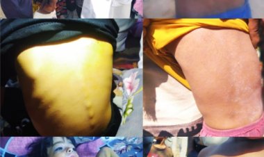 الحصبة تفتك بأطفال زنجبار: تحديات مكتب الصحة في مواجهة الوباء .. تقرير