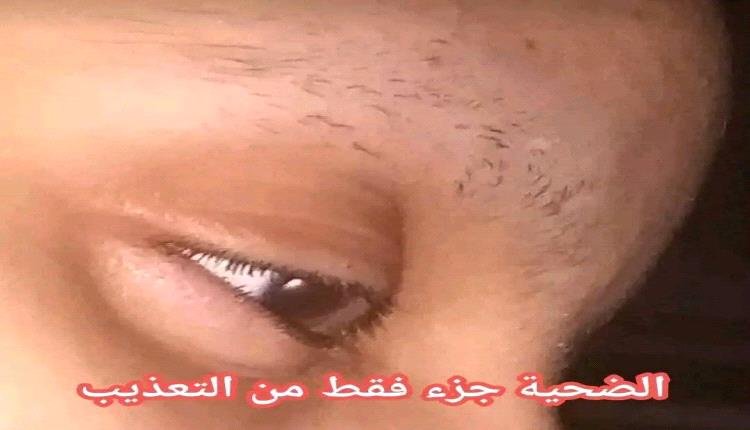 حلق شعرها وحواجبها ثم احرقها .. محامي يعذّب زوجته بطريقة مروعة في تعز