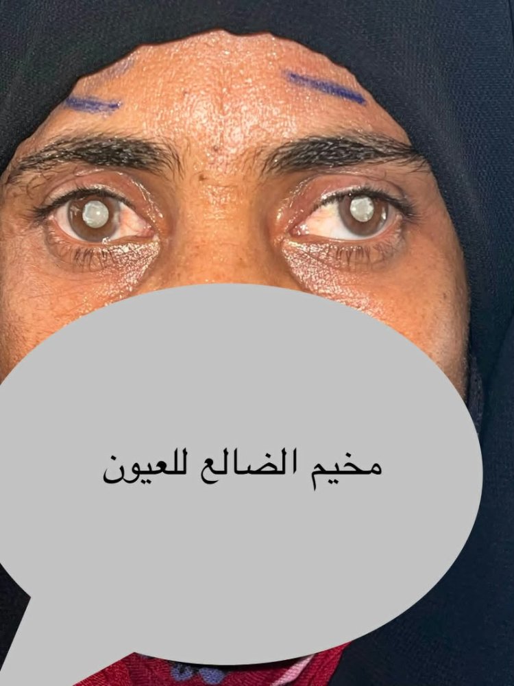 من ظلمة العمى إلى نور الأمل.. قصة أم من الضالع تبكي سنوات ضاعت من بصرها ..